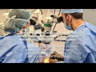 Chirurgie de la cataracte